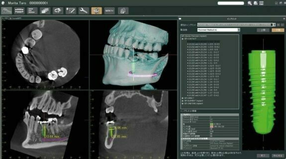 MORITA i-Dixel Software | 77642