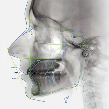 Planmeca Romexis Cephalometric Analysis | 105601