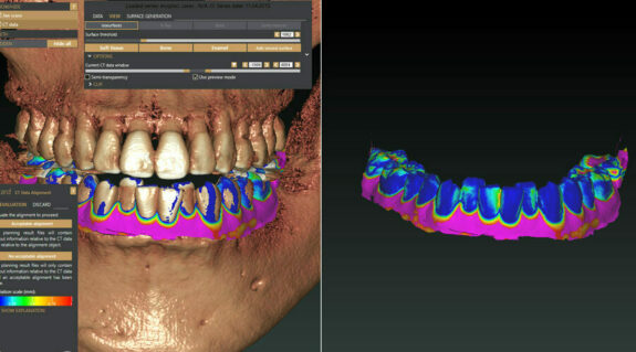 Exoplan für MORITA Implantat-Planungsprogramm | 156076