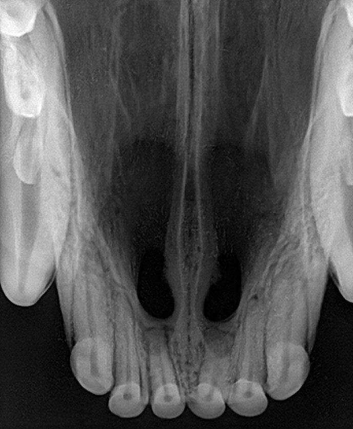 Digitaler Röntgensensor  Größe 1 20 x 30  oder 1.5 25 x 30 mm über Twain für Sidexis, Dürr ,  Kavo Cliniview usw | 182918