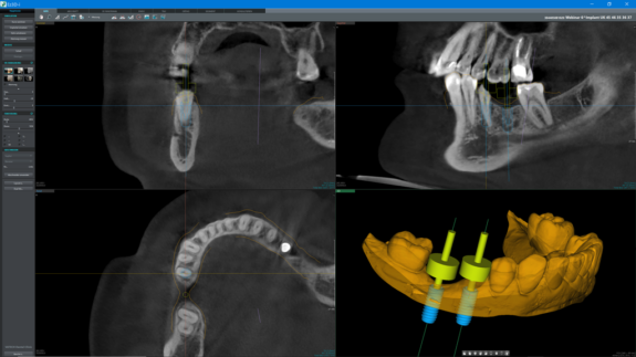 orangedental byzz® Ez3D-i | 187277