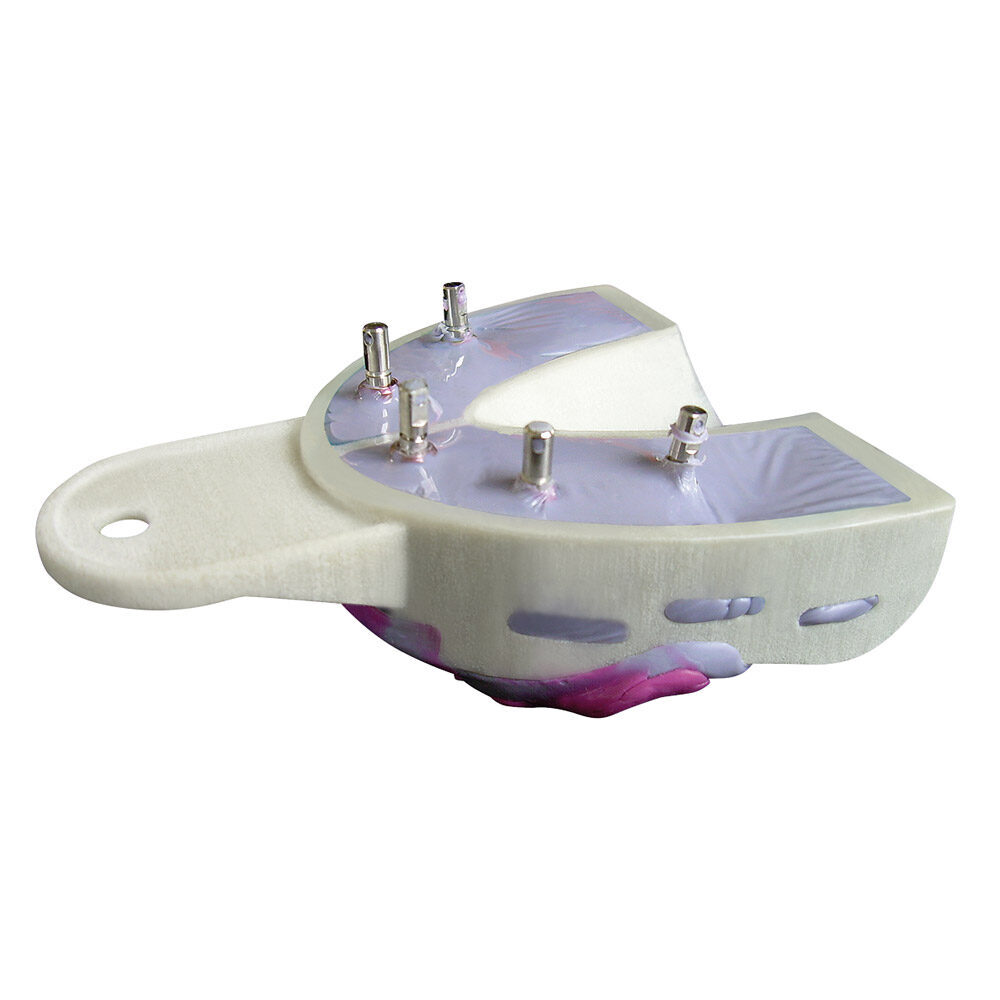 Miratray Implant UK I2 6St Set | 254696 Miratray Implant UK I2 6St Set | 254696