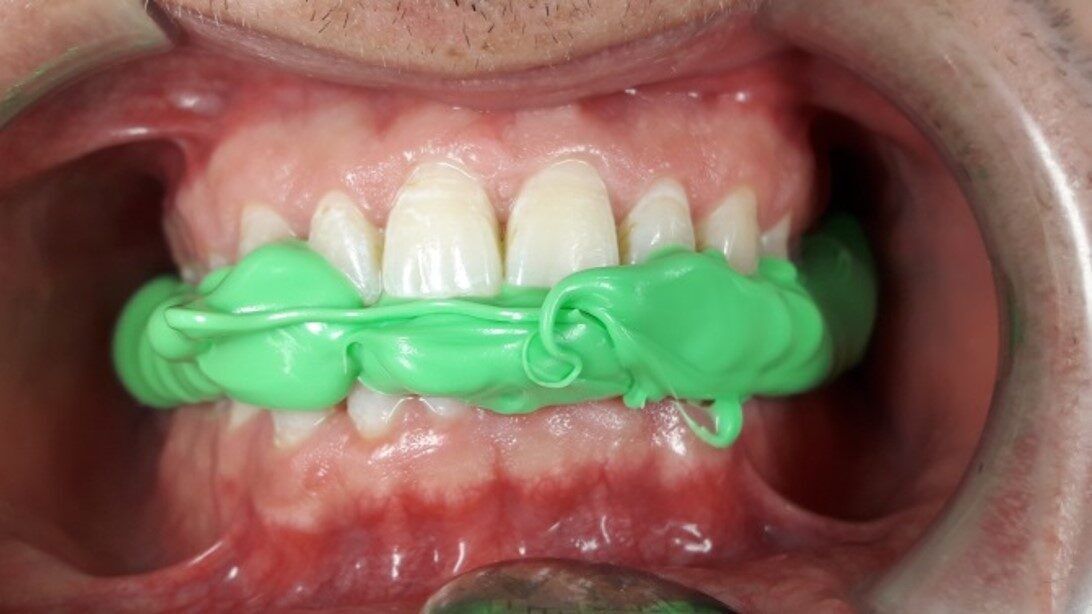 Cumdente thixotrop Key | 410060