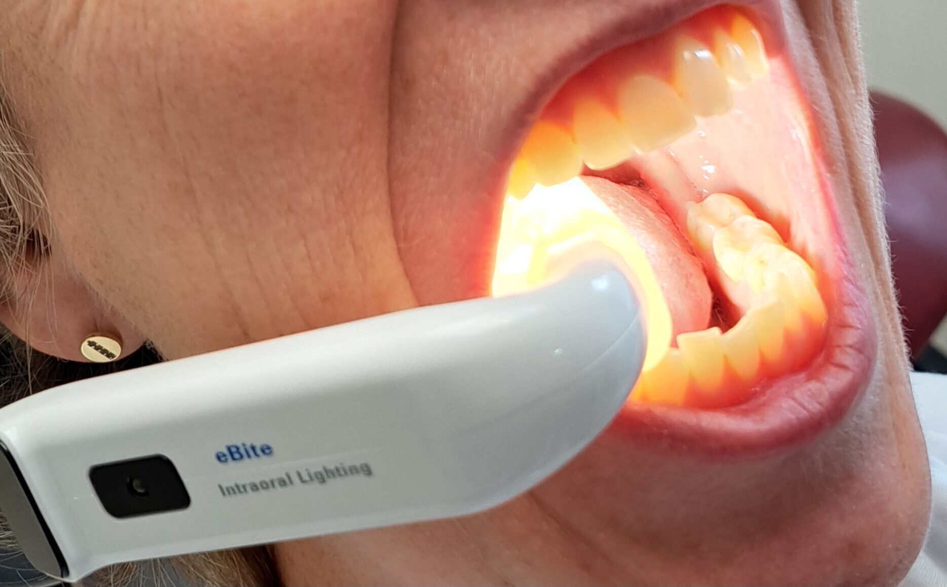 E-Bite | 333874 E-Bite | 333874