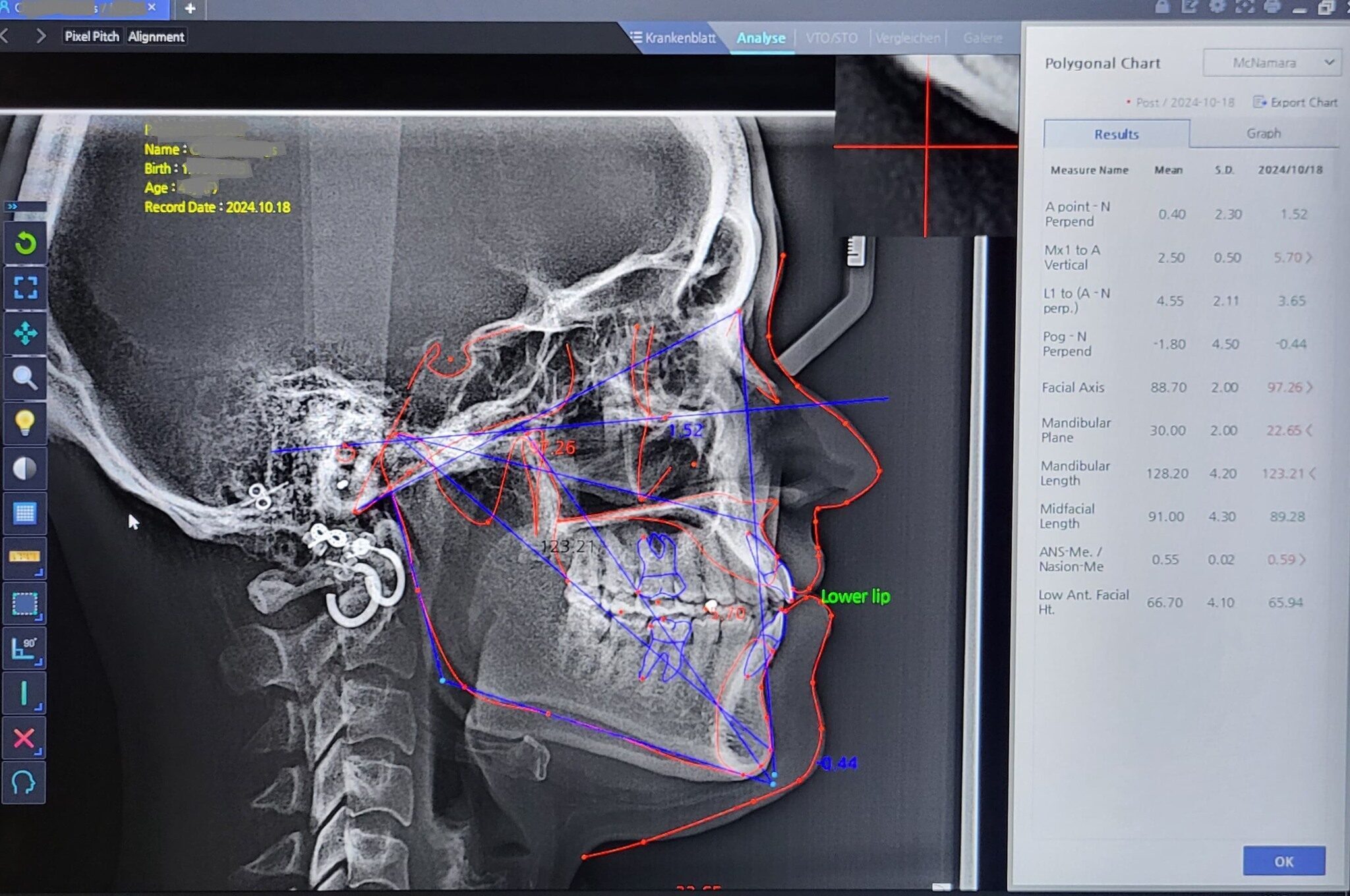 HDX WILL ECO-X DVT / XRAYdental Jubiläumsangebot | 334333 HDX WILL ECO-X DVT / XRAYdental Jubiläumsangebot | 334333