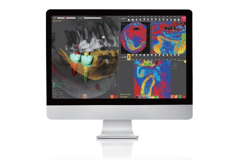 R2Gate Implantat-Chirurgie | 336908