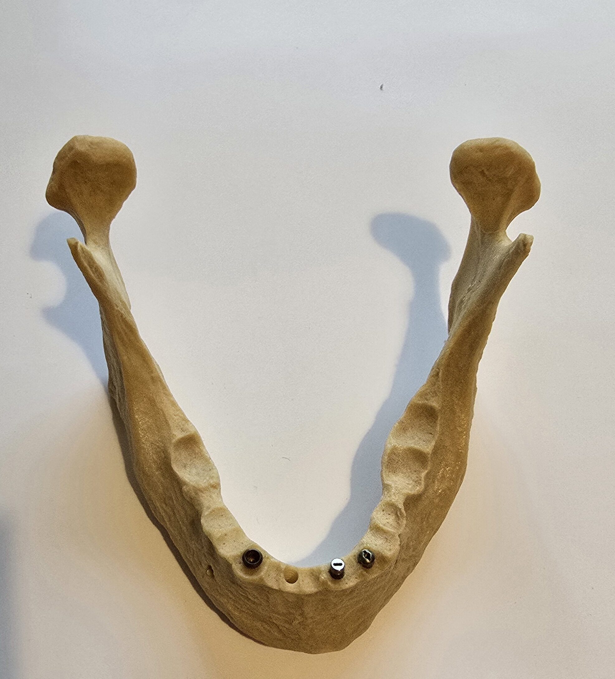 Übungskiefer Demonstrationsmodell Implantate | 338007