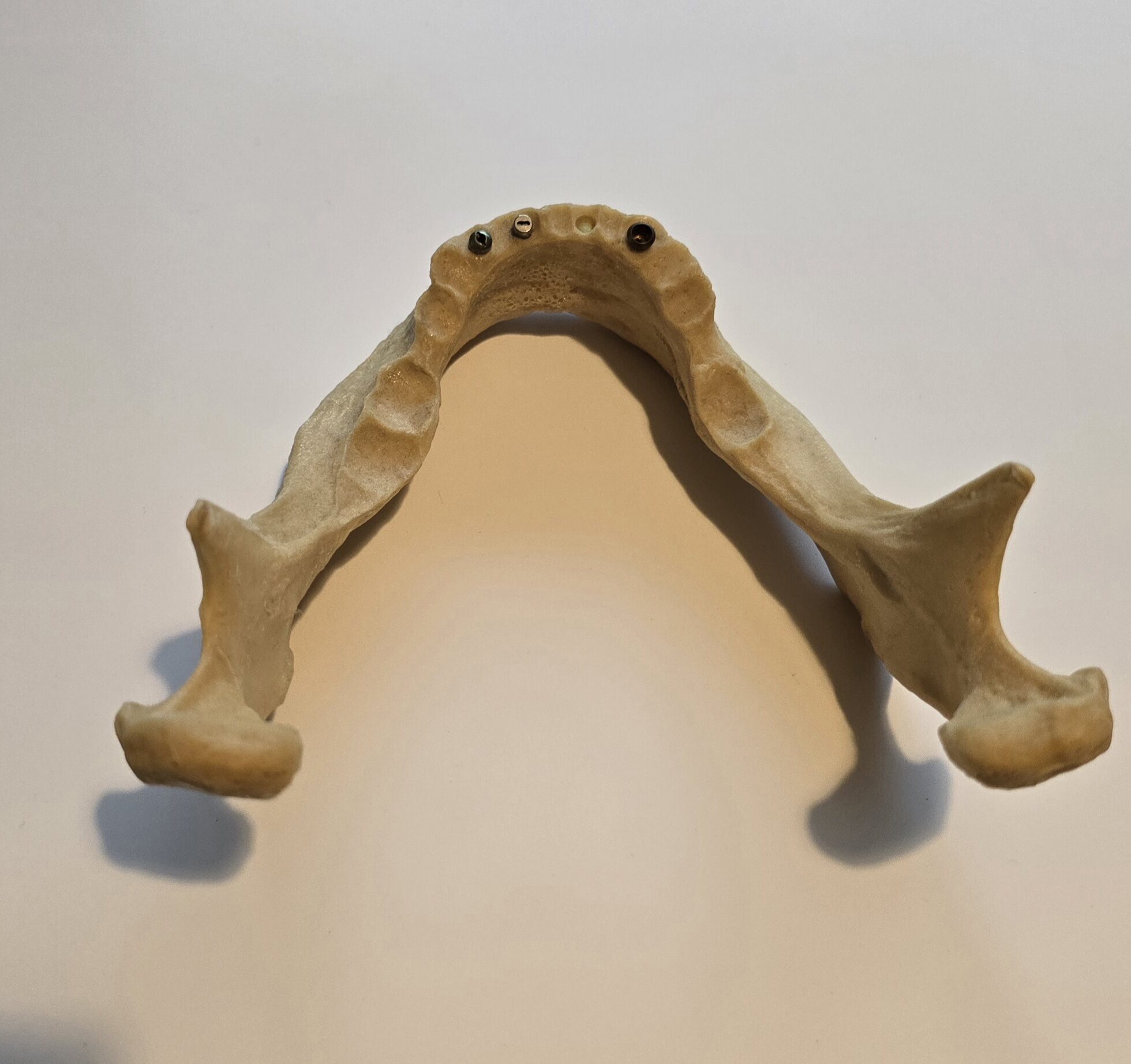 Übungskiefer Demonstrationsmodell Implantate | 338008