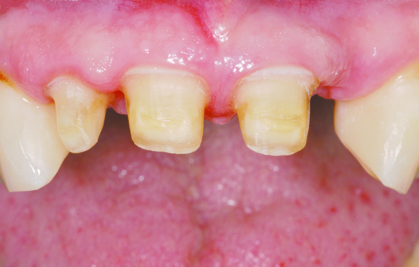 Dreve Fixtemp C&B 4:1 – Provisorische Versorgung | 340524