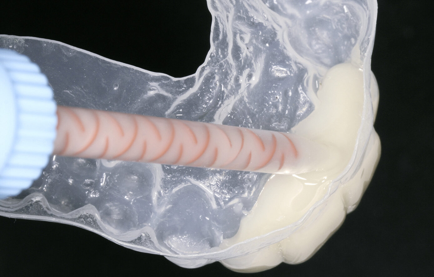 Dreve Fixtemp C&B 4:1 – Provisorische Versorgung | 340525