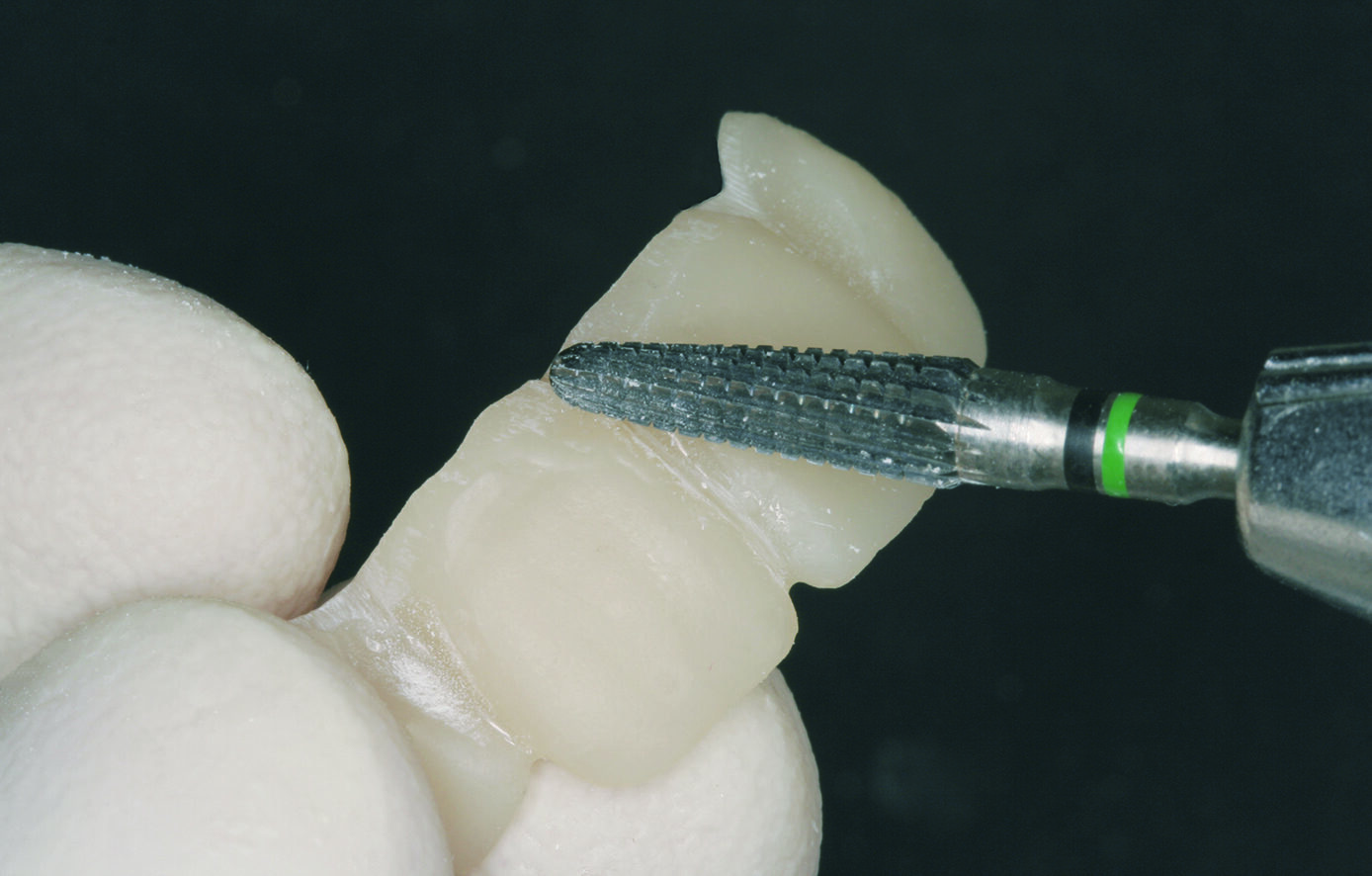 Dreve Fixtemp C&B 4:1 – Provisorische Versorgung | 340526