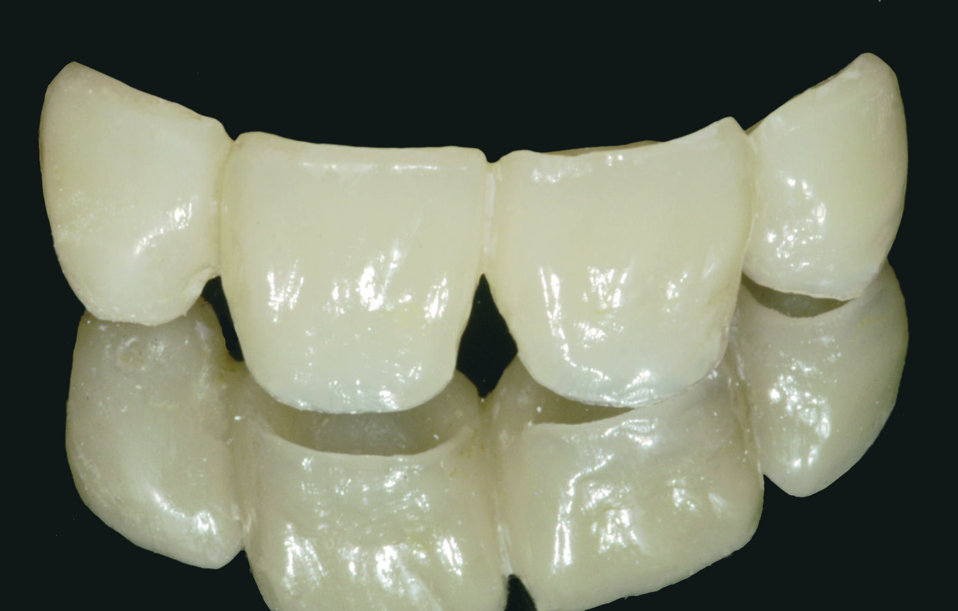 Dreve Fixtemp C&B 4:1 – Provisorische Versorgung | 340527