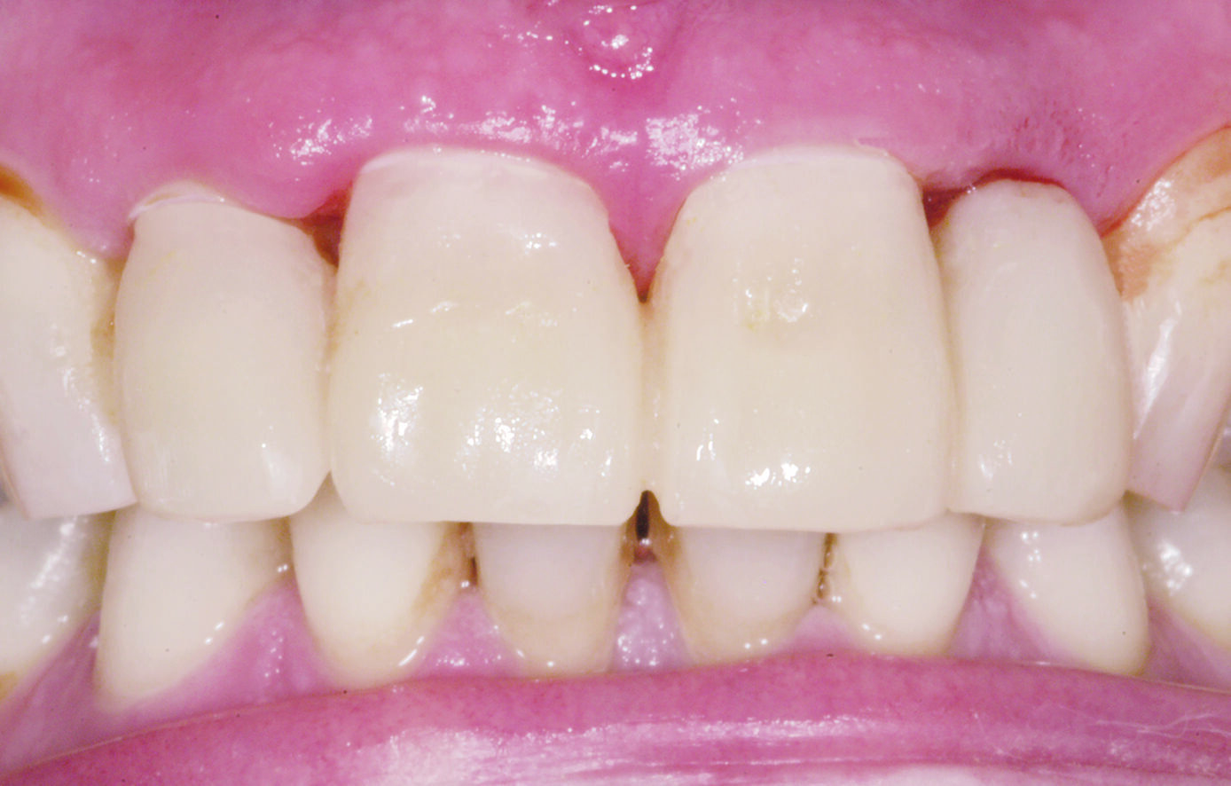 Dreve Fixtemp C&B 4:1 – Provisorische Versorgung | 340528