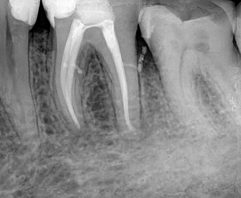Digitaler Röntgensensor  Größe 1 ca. 21 x 35 oder 1.5 ca. 25 x 35 mm auch über Twain für Sidexis, Dürr ,  Kavo Cliniview usw | 341806