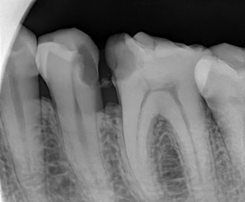Digitaler Röntgensensor  Größe 1 ca. 21 x 35 oder 1.5 ca. 25 x 35 mm auch über Twain für Sidexis, Dürr ,  Kavo Cliniview usw | 341803
