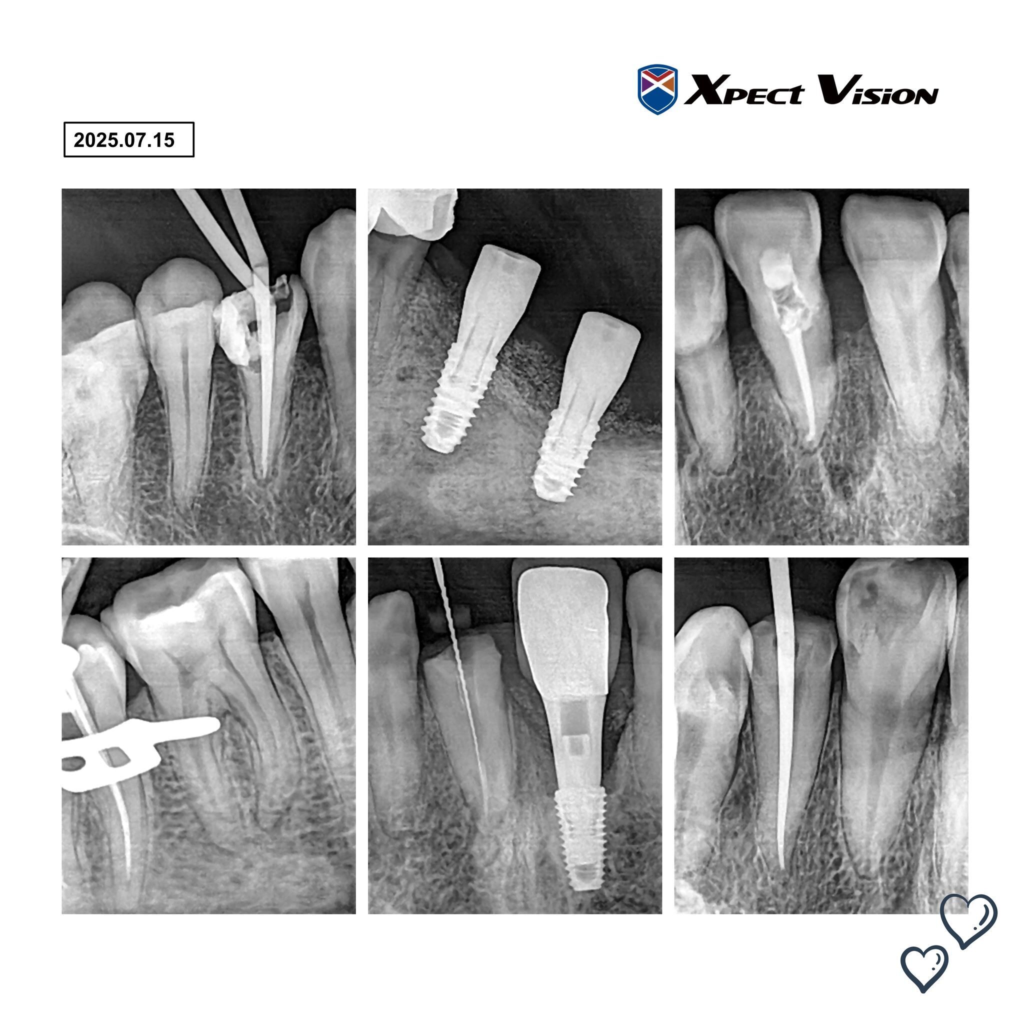 Digitaler Röntgensensor  Größe 1 ca. 21 x 35 oder 1.5 ca. 25 x 35 mm auch über Twain für Sidexis, Dürr ,  Kavo Cliniview usw | 341804