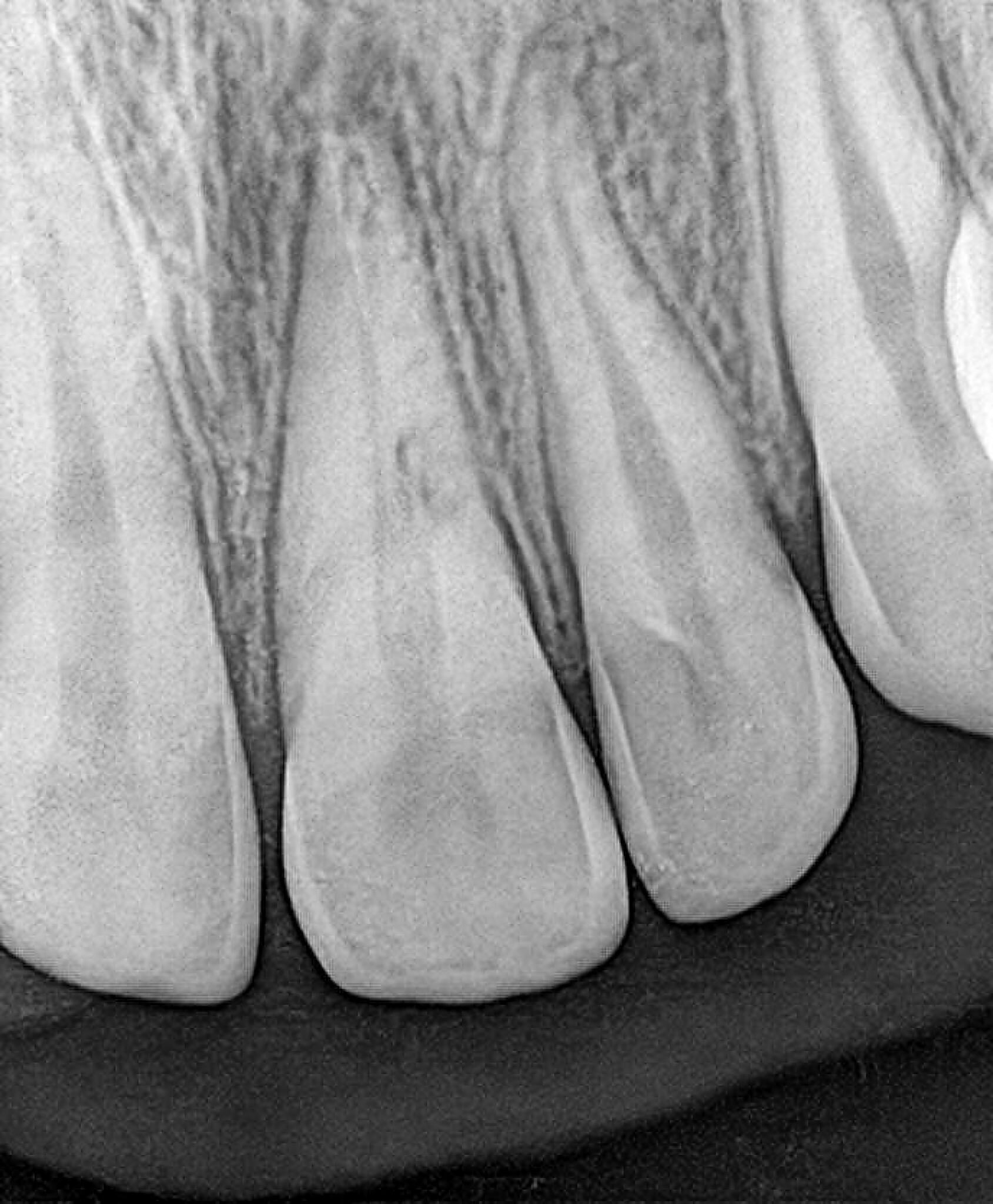 Digitaler Röntgensensor  Größe 1 ca. 21 x 35 oder 1.5 ca. 25 x 35 mm auch über Twain für Sidexis, Dürr ,  Kavo Cliniview usw | 341805