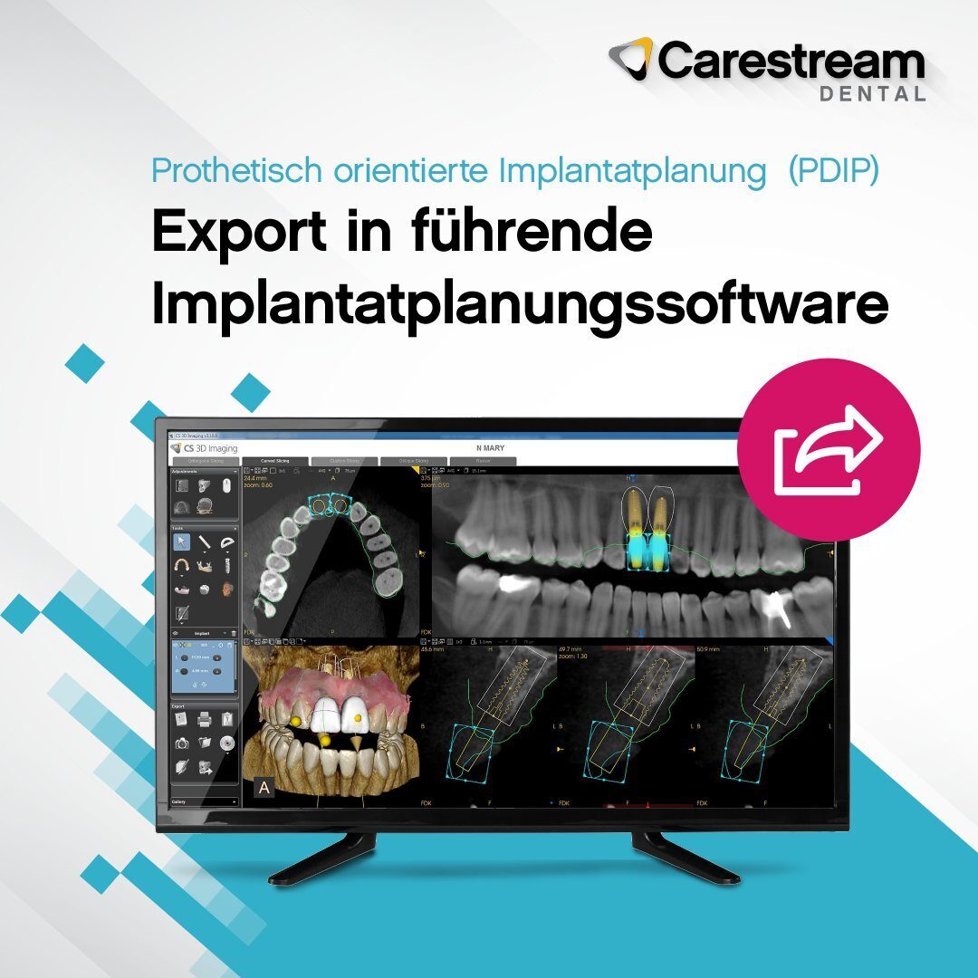 Carestream PDIP Implantatplanung leicht gemacht | 342759