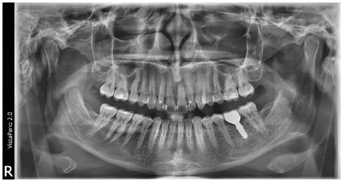 Dürr Dental VistaPano S 2.0 Digitales Panoramaröntgengerät mit S-Pan-Technologie, NEU | 386249