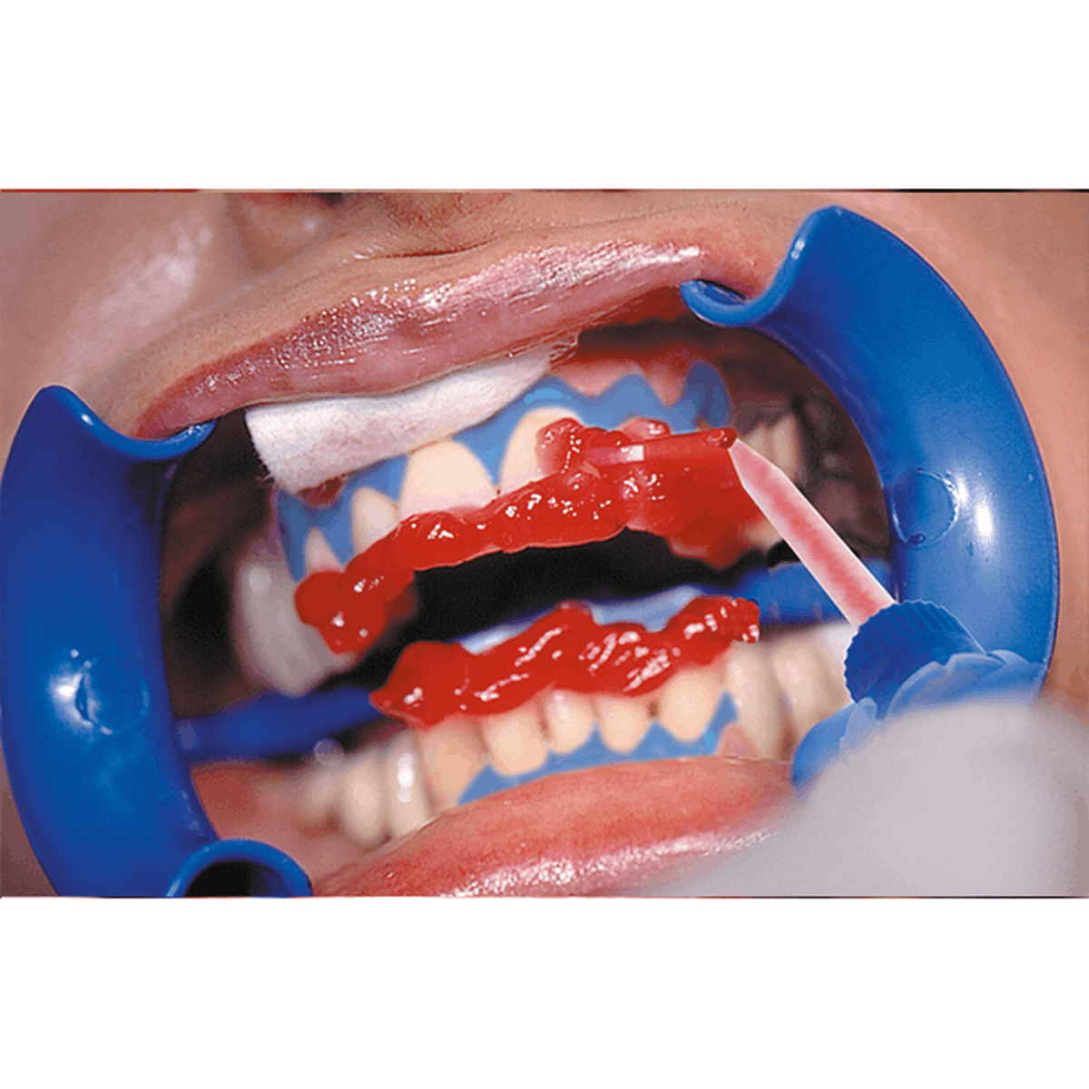 Schütz Dental Bleach’n Smile Automix Set | 429466