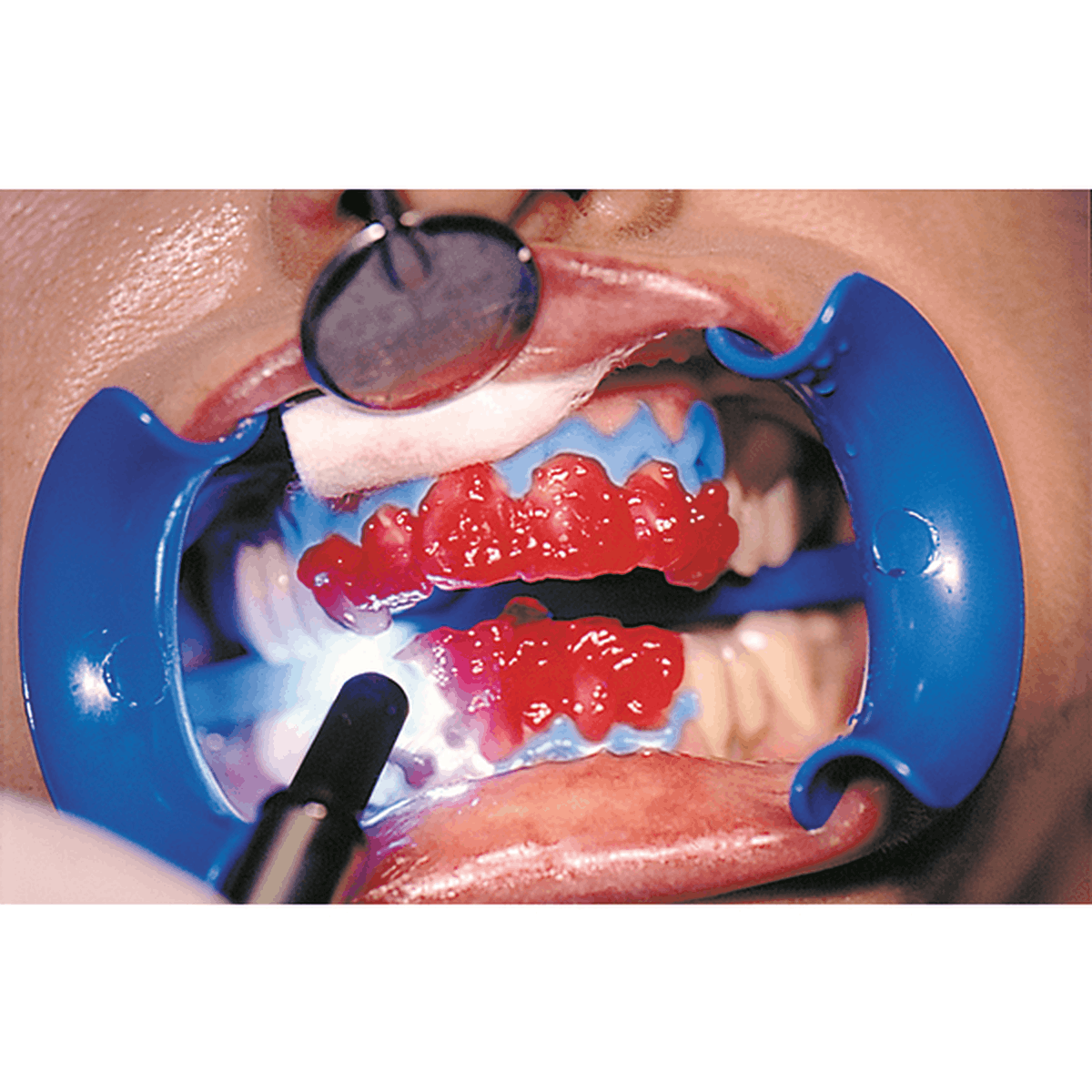 Schütz Dental Bleach’n Smile Automix Set | 429467