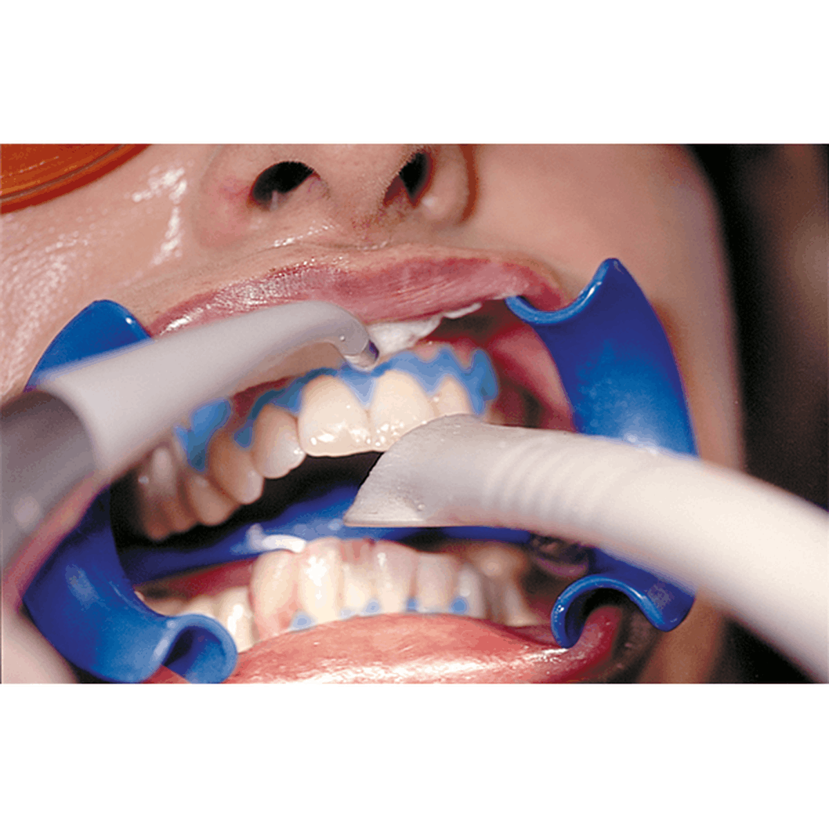 Schütz Dental After Bleaching Care Refill Set | 429461