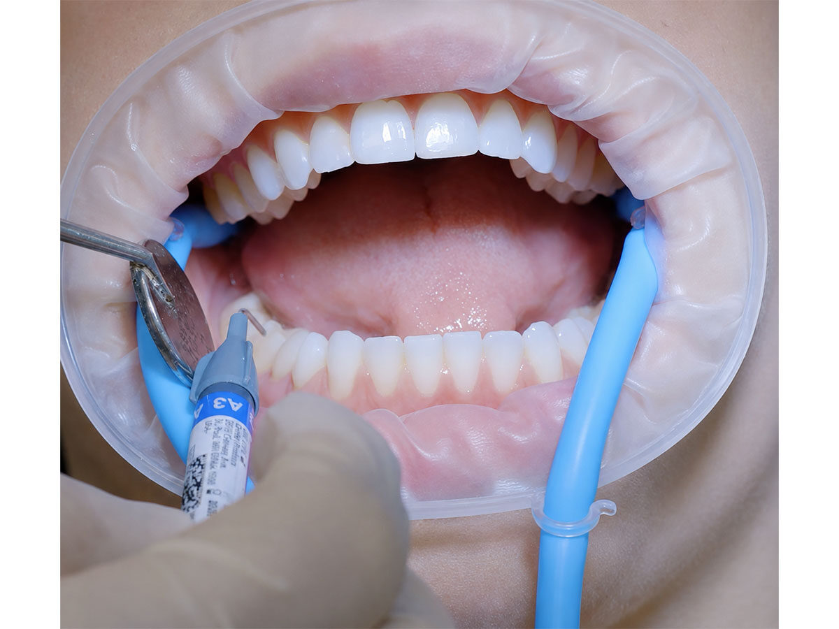 AKTION: Kostenlos testen – HIPPO-D Lippen-Wangen-Halter | 388343