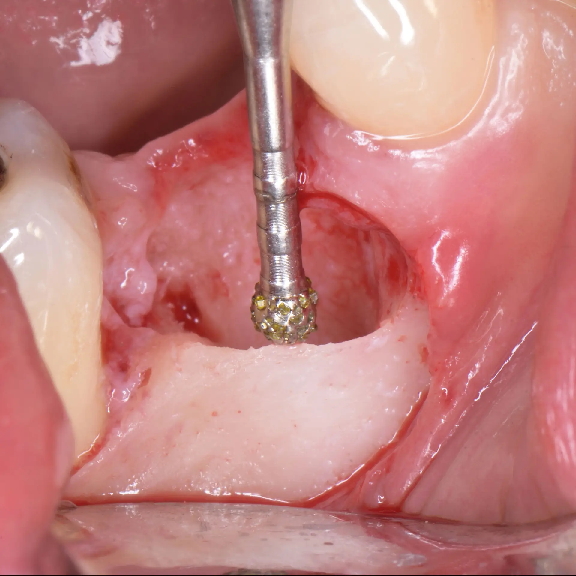 Degranulations Spezial Diamanten | 430373