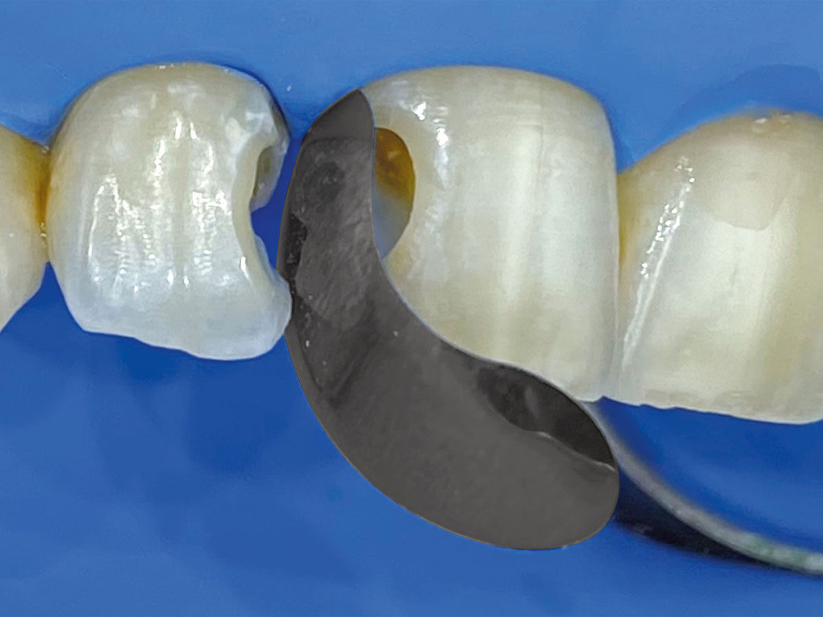 QuickmatFLEX Teilmatrizen, Molar (100) | 422637