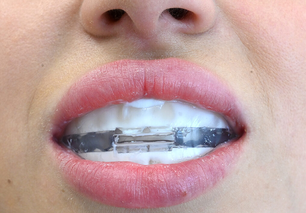 ApaCare Remineralisations- und MIH-(Kreidezähne-) Set | 410201